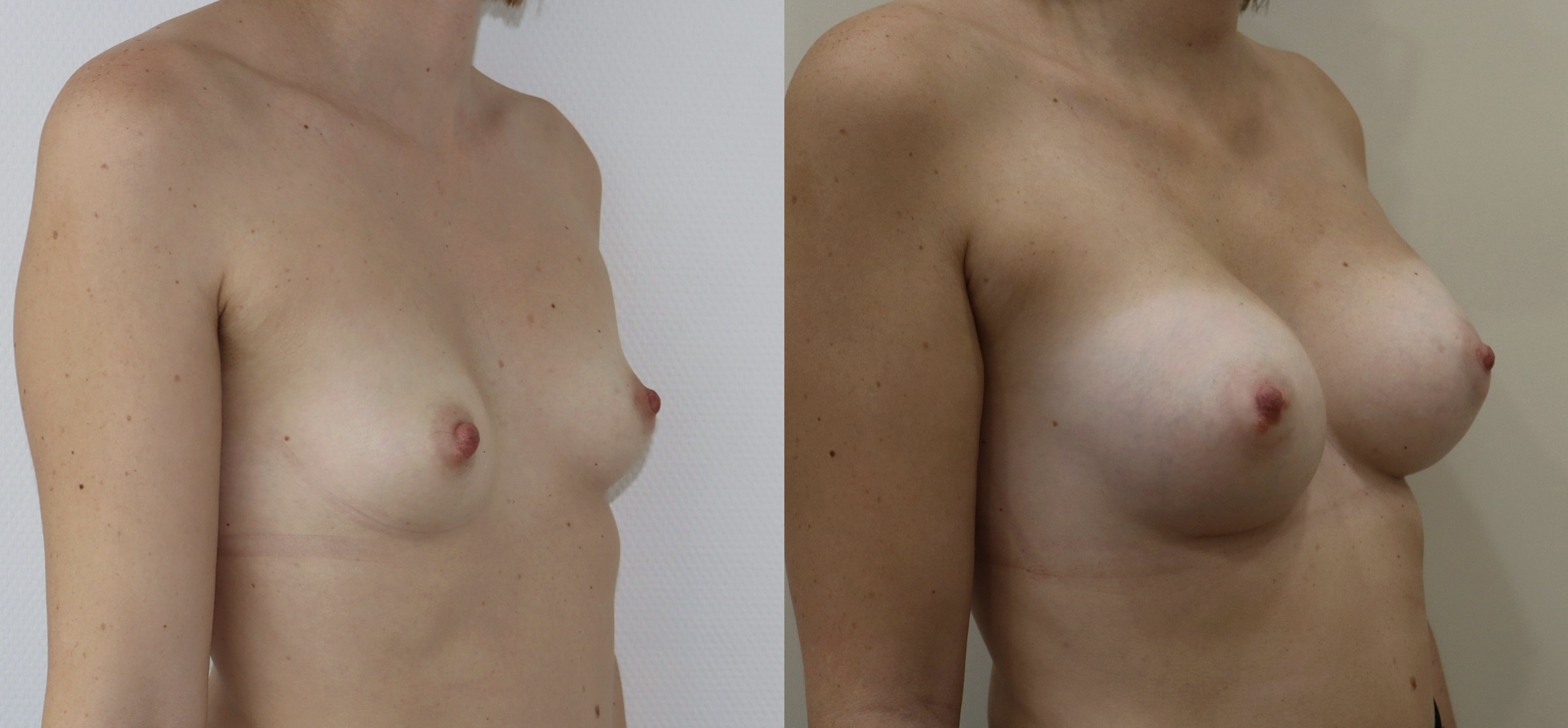 Avant/Après prothèses mammaires